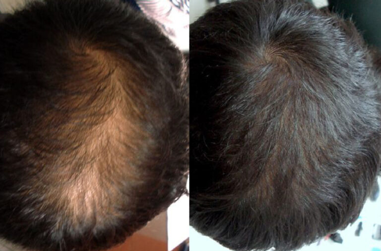 Hair Transplantation 